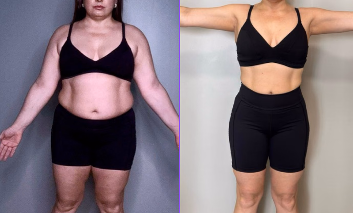 Fabiana — antes e depois com o Protocolo 5D
